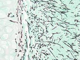 Aspergillosis is a fungal infection of usually the lungs, caused by the genus aspergillus, a common mold that is breathed in frequently from the air around, but does not usually affect most people. Aspergillose Wikipedia