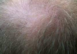 They cover your hair loss and will protect your head from. Bald Patches May Not Spell Permanent Hair Loss Health News Asiaone