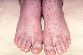 Pediatricians can diagnose viral rashes by observing the rash and the history of signs and symptoms in the babies. Meningitis Nidirect
