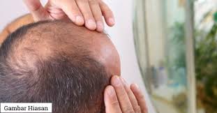 More images for punca rambut sering gugur » Pakar Buat Kajian Kepala Boleh Jadi Botak Lebih Awal Jika Bekerja Lebih 40 Jam Seminggu