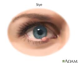 Unlike whiteheads, which contain pus, milia aren't a sign of. Eyelid Bump Medlineplus Medical Encyclopedia
