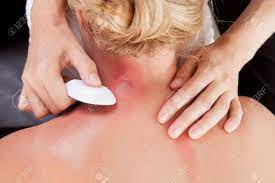 Bei einer gua sha behandlung wird die eingeölte haut mit einem gegenstand bearbeitet. Above View Of Woman Receiving Gua Sha Treatment On Back And Neck Stock Photo Picture And Royalty Free Image Image 11538687