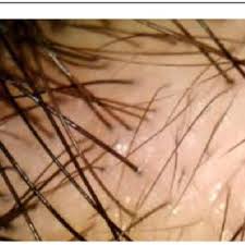 Some chemotherapy drugs are more likely than others to cause hair loss, and different doses can cause anything from a mere thinning to. Thin Slow Growing Hair Over Affected Area With Adjacent Good Terminal Download Scientific Diagram