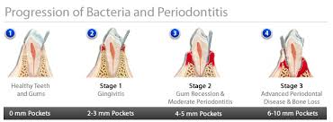 Gum Disease Periodontal Treatment In Brandon Fl Dr Fadi