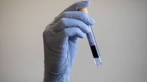 Blood tests to detect cancer. New Blood Test Provides Breakthrough In Lung Cancer Detection Rates Itv News