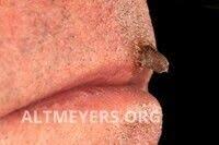 Image result for cornu cutaneum)