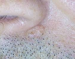 They are commonly found on the head, neck, and arms, yet can form anywhere on the body, including the chest, abdomen, and legs. Basal Cell Carcinoma Wikipedia
