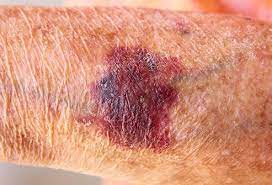 Woman complained of asymptomatic petechiae that appeared after approximately an hour of sun exposure and involved the legs exclusive right ankle of patient 24 hours after natural sunlight exposure (60 minutes). Actinic Purpura Vs Senile Purpura