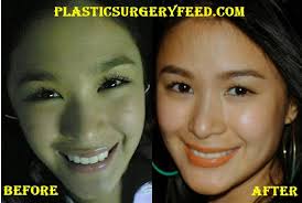 Rey ongpauco, the father of heart evangelista, revealed his reason for not attending his daughter's wedding. Heart Evangelista Plastic Surgery Plastic Surgery Feed