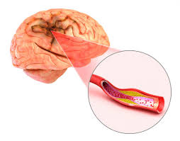 However, about 3% of people with a brain aneurysm will. Aneurysm Causes Symptoms And Treatments
