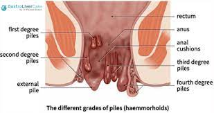 Postpartum Hemorrhoids My Struggle And Some Advice Mr Storkey
