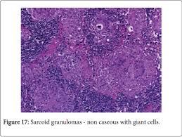Maybe you would like to learn more about one of these? Infective Germination Granulomatous Inflammation Lymph Node