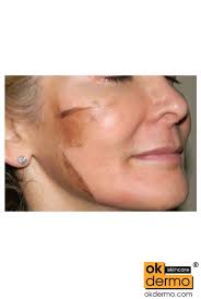 Micro Tretinoin Gel: Elevate Your Skincare Game With Retin-A Micro