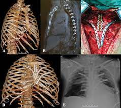 The sternum or breastbone is a long flat bone located in the central part of the chest. Simultaneous Surgical Treatment Of Sternum And Costal Cartilage Fractures The Annals Of Thoracic Surgery