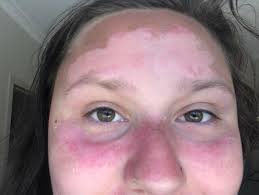 Maybe you would like to learn more about one of these? How To Treat Sunburn Flaky Skin Relax It Will Go Salubrify