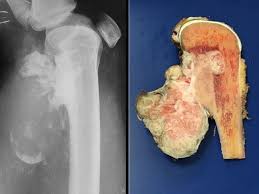 Image result for Osteosarcoma