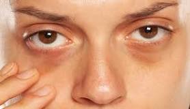 Image result for top questions about eye wrinkles bags & dark circles