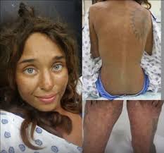 In August 2017, Lisa Theris, 25, was lost for 28 days in the dense forests  of Midland, Alabama. Without shoes, a phone, or supplies, she survived by  eating berries, wild mushrooms, and