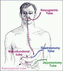 Introduction Alfa Enteral Feeding Nursing Care Plan Feeding Tube