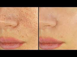 5 Ways To Shrink & Unclog Pores Immediately - Youtube