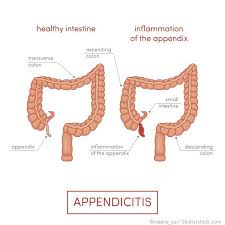 It was removed 2 years before i was born.i hope. What Is The Appendix