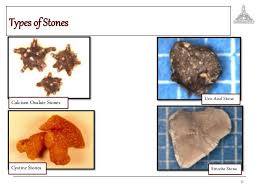 Pin On Kidney Stones