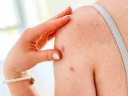 Image result for Papular Acrodermatitis
