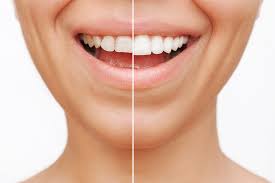 Enhance Your Smile with Dental Veneers: The Secret to a Radiant, Confident  Smile - Dentist Surrey