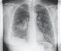 Often there is no external sign of breast cancer. Radiological Staging In Breast Cancer Which Asymptomatic Patients To Image And How British Journal Of Cancer