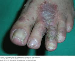 Image result for Tinnea vesiculosa