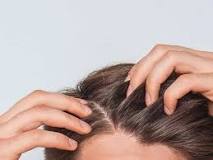 Image result for what is the best over the counter treatment for scalp eczema/psoriasis