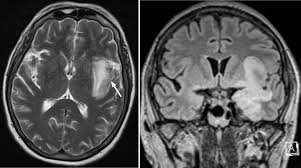 Having said that, mri with contrast is considered the most sensitive imaging modality, and findings are present in over half of individuals 8. Https Www Birpublications Org Doi Pdf 10 1259 Bjrcr 20170114 Download True