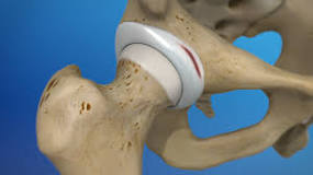 Image result for icd 10 code for labrum tear right hip