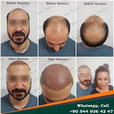 Best Hair Transplant Doctor In Turkey Dr Zen Hair Clinic Olcay Saygin 2020