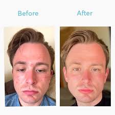 We did not find results for: Customized Skin Clearing Supplements Mdacne