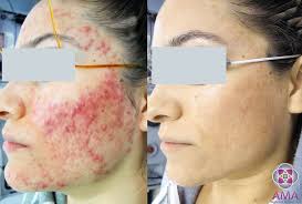 laser acne treatment to eliminate