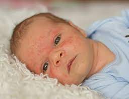 Acne Neonatal O Que E E Como Cuidar Mustela