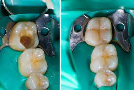 I Ve Lost A Filling Is This Urgent Dr Michael Krochak D M D Dental Blog