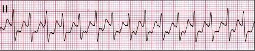 Paroxysmal supraventricular tachycardia (psvt) is episodes of rapid heart rate that start in a part of the heart above the ventricles. Paroxysmal Supraventricular Tachycardia Diagnosis And Management