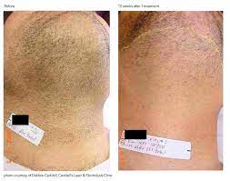 Laser hair removal can be dangerous in inexperienced hands. Pin On Laser Hair Removal