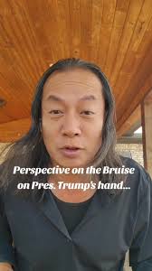 So much talk about the bruise