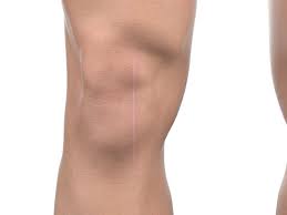 Usually the scar from the knee replacement surgery fades to a pale thin line approximately 4 to 6 months after surgery. Patient Education In Orthopedic Surgery Orthoillustrated