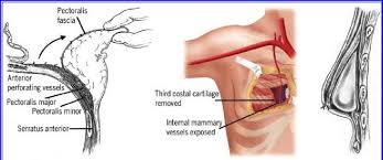 The pectoralis minor is a thin, triangular muscle beneath the pectoralis major. Examples Of Pectoralis Major Pm Muscle Trauma Associated With Breast Download Scientific Diagram