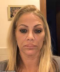 Mother claims she has been left with 'Barbie lips and a piggy snout' after  five 'botched' surgeries