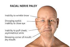 Bell's palsy is a weakness (paralysis) that affects the nerve fibres that control the muscles of the face. Coronavirus Man Has Bell S Palsy After Both Pfizer Jabs