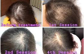 If you are looking to avoid both the aggravation of a slow recovery and the embarrassment of hair loss, prp therapy might be the right treatment. Prp For Hair Loss How Does It Restore Your Hair