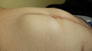 Maybe you would like to learn more about one of these? Do Hernias Go Away On Their Own Michigan Hernia Surgery