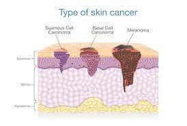 What does skin cancer look like? Skin Cancer When Mohs Surgery Is The Best Treatment Thirdage