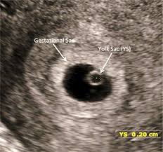 Image result for First Trimester Ultrasound