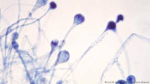 ¡mucormicosis, hongo negro que esta mutilando a pacientes con covid!la mucormicosis es una enfermedad producida por hongos, q. India Lucha Contra Oleada De Casos De Hongos Negros Una Rara Infeccion Que Aumenta Entre Pacientes Con Covid 19 Coronavirus Dw 20 05 2021
